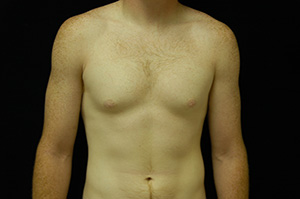 Gynecomastia 3a